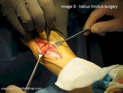 Hallux Limitus | Causes And Treatment Options | MyFootShop.com